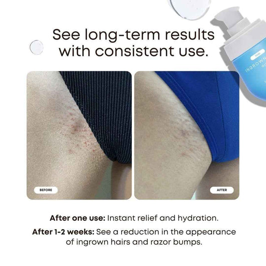 Bushbalm Ingrown Hair Oil - Targets Ingrown Hairs, Razor Bumps and Post Shave Irritation - Soothes and Hydrates Skin, 30 ml - Nude 🍁 All In One Marketplace Canada